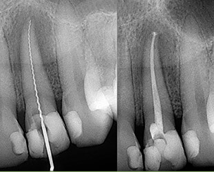 X-rays of root canal treated tooth