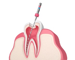 Illustration of root canal therapy 