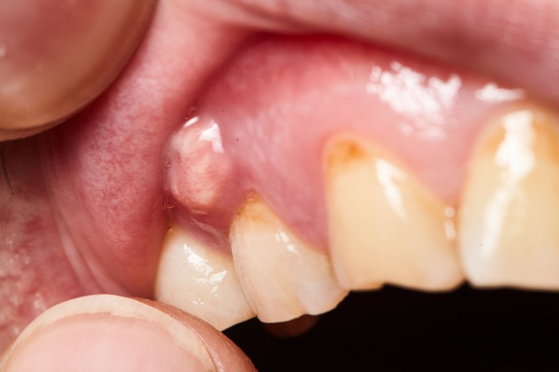 Abscessed gums and infected teeth in need of root canal