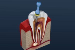 Infected tooth needing a root canal