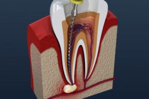 an illustration of a tooth that is infected