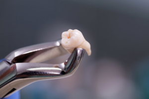 Forceps holding a wisdom tooth