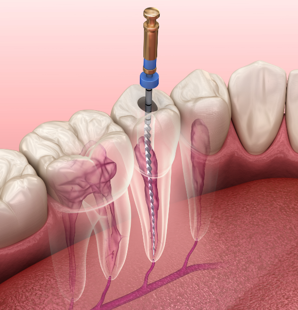 3D image of a root canal